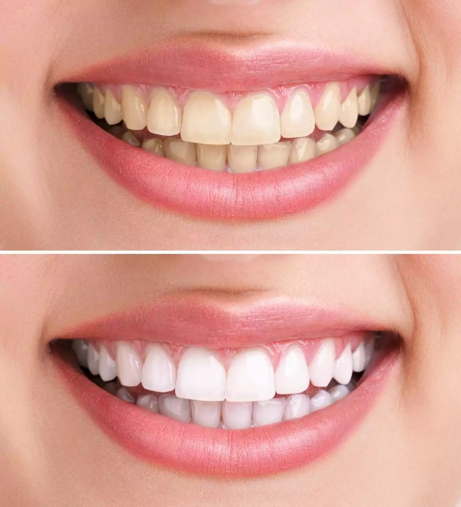 Blanchiment des dents