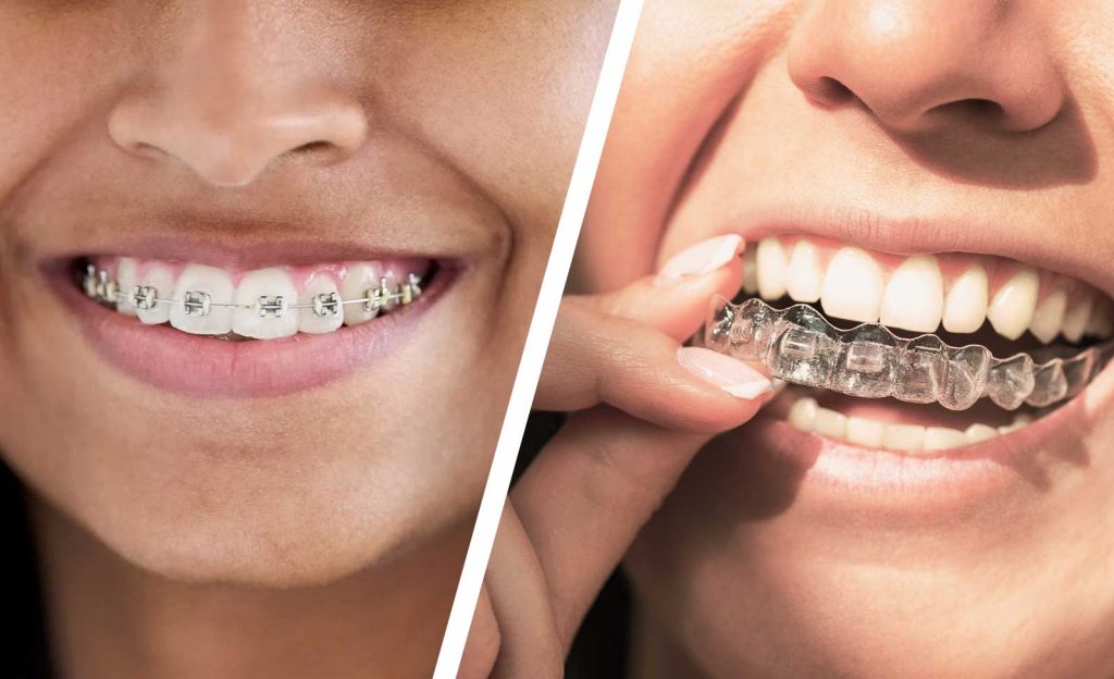 Orthodontie adulte