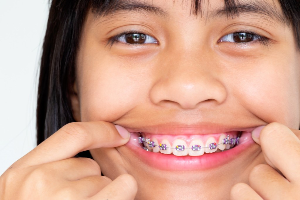 Orthodontie enfant